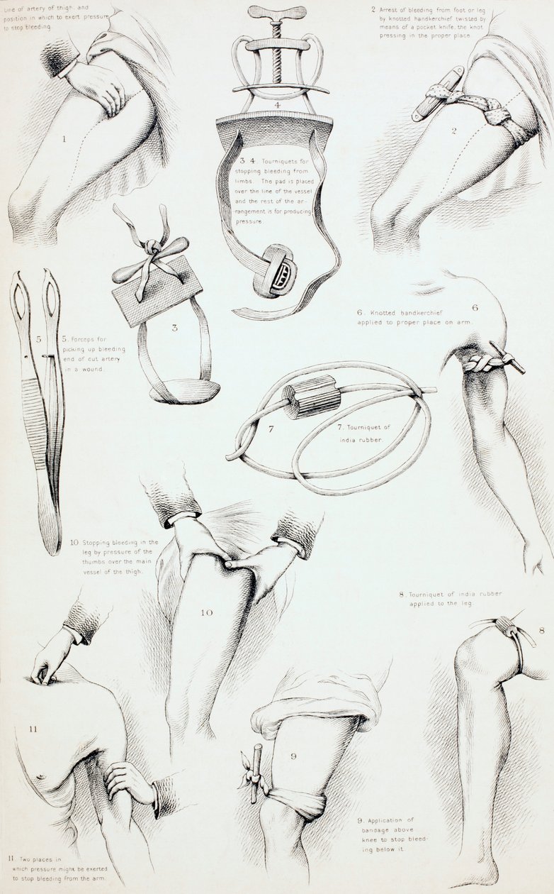 遏制出血的方法，c.1890 作者 英语学校